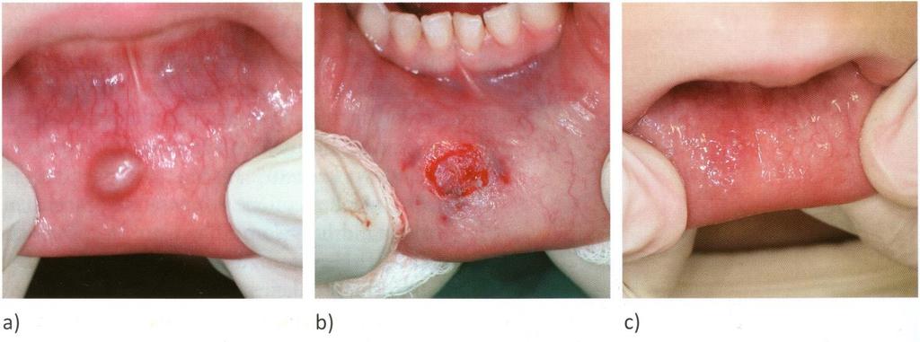 7.3. Mukokela Mukokela ili mukozna cista benigna je lezija nastala od malih žlijezda slinovnica.