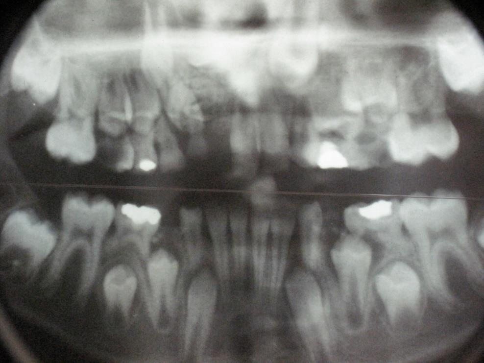 8. BENIGNI TUMORI ČELJUSTI 8.1. Odontom Odontom je odontogeni benigni tumor sastavljen od tvrdog zubnog tkiva.