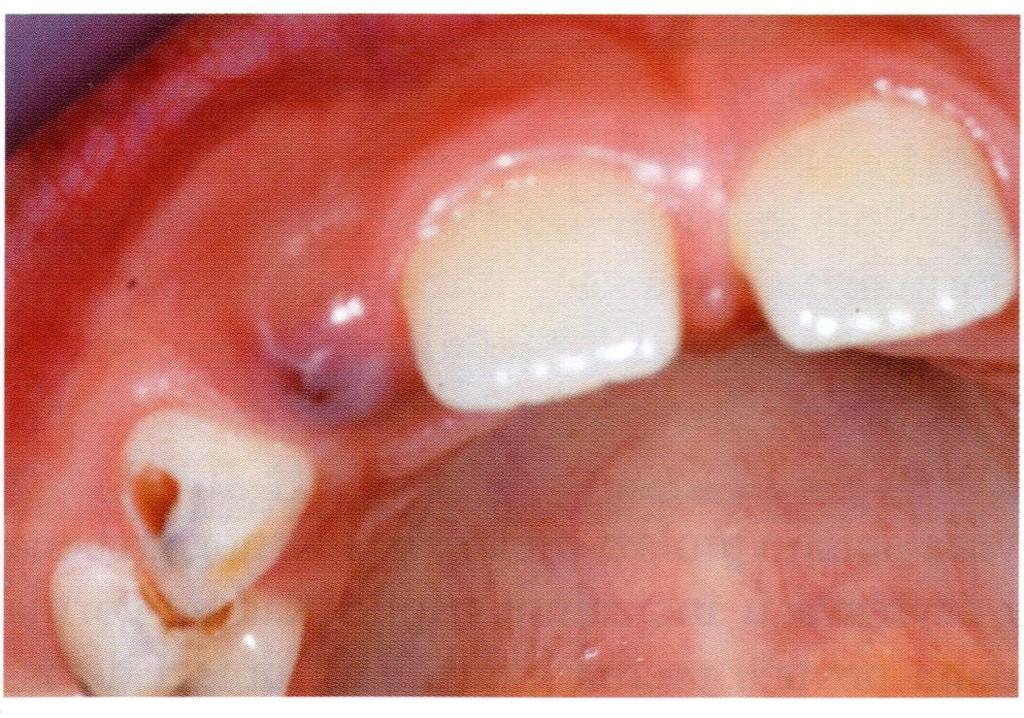 9.4. Eruptivna cista Eruptivna cista ili eruptivni hematom benigna je cistična lezija koja se pojavljuje neposredno prije nicanja trajnih zuba i nestaje prilikom pojave tih zuba u usnoj šupljini