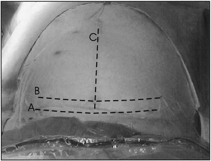 Slika 1. Rezovi abdominalne stijenke. A. Rez prema Pfannenstielu B. Joel-Cohen rez C. donja medijalna laparotomija (6) Metode histerotomije uključuju: 1. klasični (Sangerov, korporalni) rez 2.