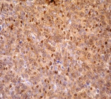 дана од убризгавања 4Т1 малигних ћелија детектована је фрагметација ДНК туморских ћелија изазвана апоптозом у карциному