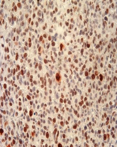 Ki-67 % Ki-67+ ћелија у туморском ткиву А) 80 60 40 20 0 Б) Нетретирани CDDP DE-EDCP Графикон 12. DE-EDCP смањује експресију Ki-67 у ткиву карцинома дојке.
