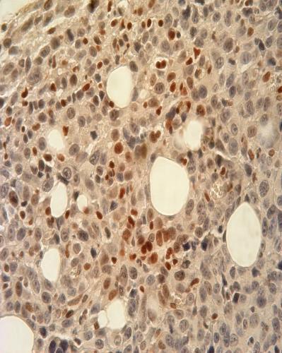 p-stat3 % p-stat3+ ћелија у туморском ткиву На крају је у ткиву карцинома дојке анализирана експресија фосфорилисане форме STAT3 (енгл.