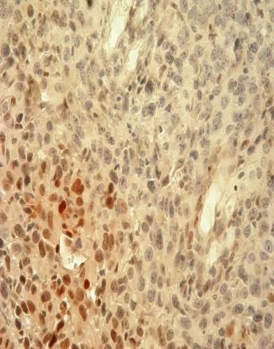 Примећује се да је процентуална заступљеност малигних ћелија које исказују рstat3 у туморском ткиву мишева третираних са DE-EDCP или цисплатином смањена у односу на нетретирану групу, али ово смањење