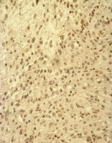 DE-EDCP значајно не мења процентуалну заступљеност малигних ћелија које исказују фосфорилисану форму STAT3 у ткиву карцинома дојке мишева.