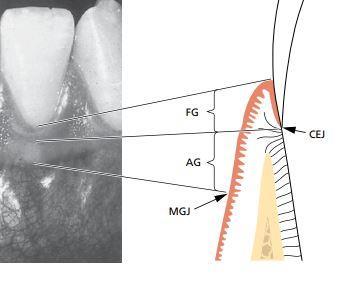 Oblik interdentalnog prostora u intaktnom zubnom luku i zdravim ustima određuje oblik interdentalne papile.
