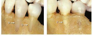 Fenestracija i dehiscencija: alveolarni nastavak je dio maksile i mandibule koji tvori i podupire zubne alveole.