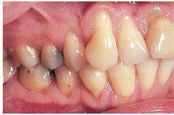 doktora o pravilnoj tehnici korištenja zubnog konca. Inicijalne lezije mogu izgledati inflamatorno dok su su hronične često asimptomatske.