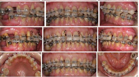 iznad zuba što se pomiče prema svom pravilnom položaju unutar alveolarnog nastavka, praćena stavaranjem kosti. (3) Slika 12. Recesije nastale kao posljedica ortodontske terapije.
