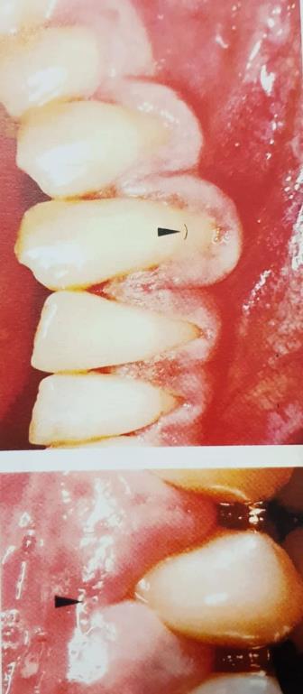 5.0. KLINIČKA SLIKA GINGIVALNIH RECESIJA Recesija se lako uočava: praćena je povlačenjem gingive u apikalnom pravcu, ogoljenjem korijena zuba i očuvanošću interdentalnih papila.