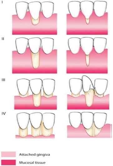 parodontitisa ili radikalnog resektivnog liječenja parodontitisa. Regeneracija tkiva hirurškim intervencijama jedva da je moguća. Slika 15. Klasifikacija recesija po Milleru.