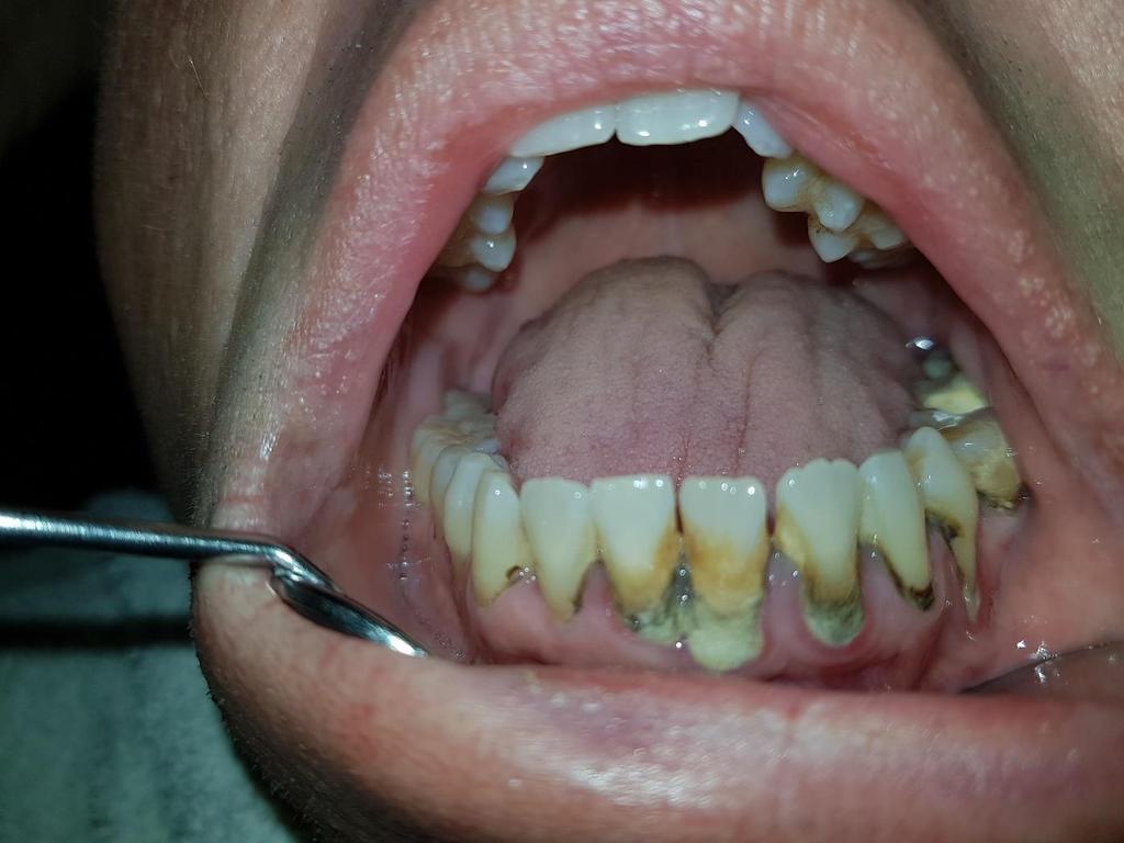 Kod parodontitisa dolazi do uništenja pričvrsnog aparata zuba. Zubno meso se odvaja od zuba, nastaju tzv. parodontni džepovi koji bivaju inficirani bakterijama i toksinima.