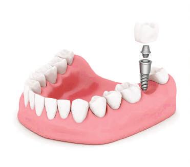 VRSTE PROTETSKOG RADA NA IMPLANTATIMA Vrste protetskog rada na implantatima Jedan zub na implantatu Na temelju rendgenske snimke radi se pregled i planira zahvat.