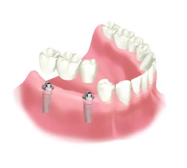Nakon cijeljenja (oseointegracije), koja traje od 3 do 6 mjeseci, uzima se otisak po kojem se radi krunica za novi zub u dentalnom laboratoriju.