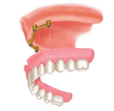 Semicirkularni most na implantatima Osobama kojima nedostaje više zubi, preporučuje se semicirkularni most na implantatima.