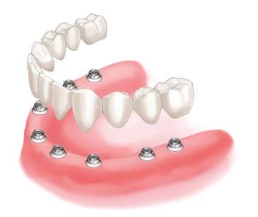 Tijekom sraštanja, ako implantat ima osnovnu stabilnost, može se nositi privremena krunica. Novi zubi izgledaju skladno, a klijent ima osjećaj kao da ima svoje prirodne zube.