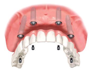 VRSTE PROTETSKOG RADA NA IMPLANTATIMA Most na 4 implantata Ova relativno nova implantološka metoda namijenjena je klijentima bez zubi ili sa zubnim protezama koji u kratkom vremenu žele novi prirodni