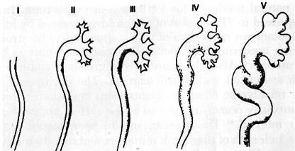 Slika 4.1. Stepenovanje VUR-a ( Izvor: Jones KV, Asscher AW. Urinary tract infection and vesicoureteral reflux. U: Edelmann CM, ed. Kidney Disease. 2 izd.