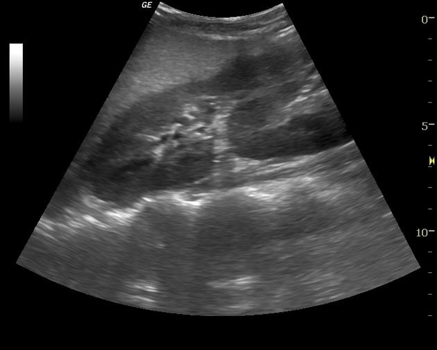 Slika 6.3. Ultrazvučni snimak pacijenta sa ukrštenom ektopijom bubrega (Izvor: KCUS) Na ukupnom uzorku od 52 pacijenta zabilježen je 1 smrtni slučaj.