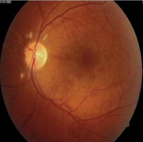 januar-mart/2017. Vol. 15 - Broj 1 Slika 3. i 4. Fundus fotografija OVCR Najzastupljenije komlikacije su: srčana insufi cijencija kod 37 (60.6%) pacijenata, zatim in - fa r kt miokarda kod 7 (11.