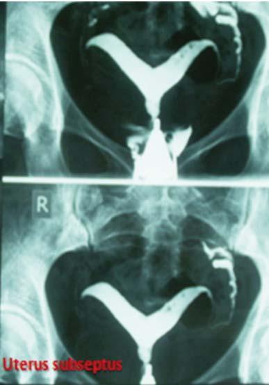 Rog materice i jajovod urednog ren d ge no - loškog nalaza. Zaključak: Uterus unicornis. 4. Uterus subseptus 9 Slika 5. Analogna histerosalpingografija (slika 5). Stav: ležeći. Prijekcija: AP.