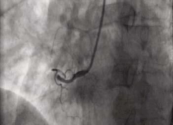 arteriju (Slika 1), pa je ura đe - na nova PPCI sa ugradnjom stenta obloženog le - kom (DES sa bio limusom) (Slika 2).
