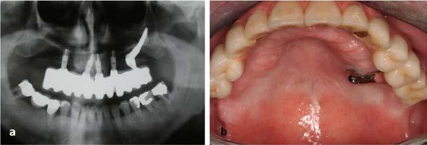 right zygomatic implant with the dental forceps. Slika 5a,b.