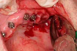 Kirurško područje s otvorenom sinusnom šupljinom nakon uklanjanja implantata Figure 11 Surgical site, with the sinus cavity being exposed, after the removal of the implant.
