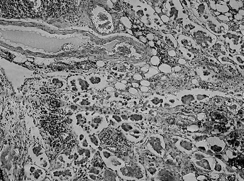 Sl. 1 Carcinoma serosum peritonei Sl. 2 Carcinoma serosum papilliferum ovarii Od ostalih tumora u peritoneumu često metastazira adenokarcinom debelog crijeva (sl. 3).