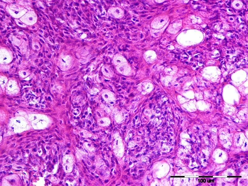 n=22 Grafikon 2: Udio pojedinih histoloških tipova tumora lojnih ţlijezda u pasa Slika