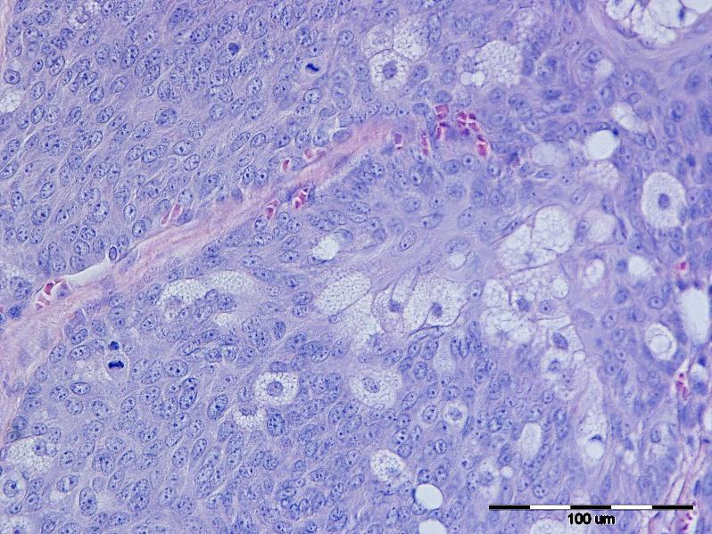 Slika 3: Karcinom lojnih ţlijezda, pas, HE, x 40 4.1.3. Rezultati imunohistokemijske pretrage Rezultati ekspresije E-kadherina u tumorima lojnih ţlijezda su prikazani u tablici 1.