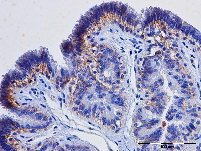 Slika 9: Adenom apokrinih ţlijezda, pas, IHC, E-kadherin, x 40 Rezultati imunohistokemijske pretrage karcinoma apokrinih ţlijezda Rezultati IHC pokazuju da je ekspresija E-kadherina u 57,1% karcinoma