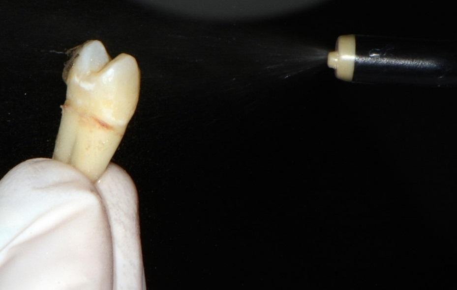 Slika 5.b Ispiranje ortofosforne kiseline sa zuba U drugoj skupini caklina je iradirana Er:YAG laserom (LightWalker AT S, Fotona, Ljubljana, Slovenija) putem X-Runner drška u SSP modu (Slika 7.