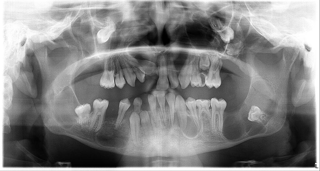 usana i nepca. U usnoj šupljini multiple keratociste uzrokuju klimanje i ispadanje zubi, a zbog potrebe za kirurškom resekcijom cističnih tvorbi pacijenta ostaje bez većine zubi. Na 4.