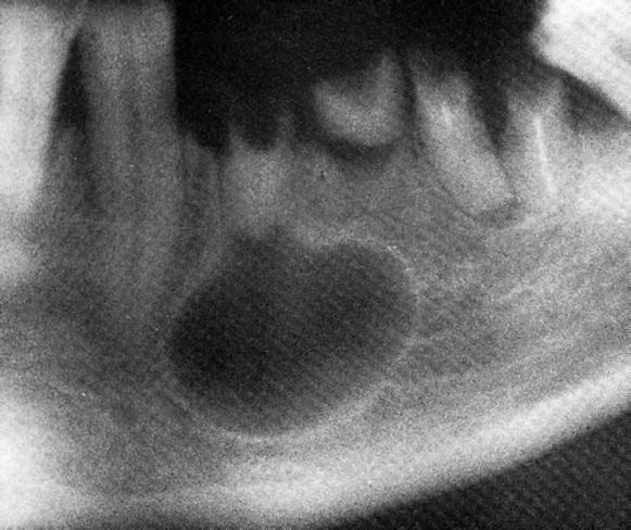 Slika 6. Radikularna cista uz donji lijevi premolar. Preuzeto s dopuštenjem doc. dr. sc. Dijane Zadravec, dr.