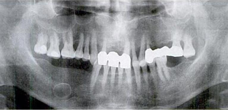 prosvjetljenje koje nije povezano sa zubom (Slika 10). Zato je u dijagnostici ciste bitan anamnestički podatak koji ukazuje da je na mjestu nastanka ciste izvedena ekstrakcija zuba.