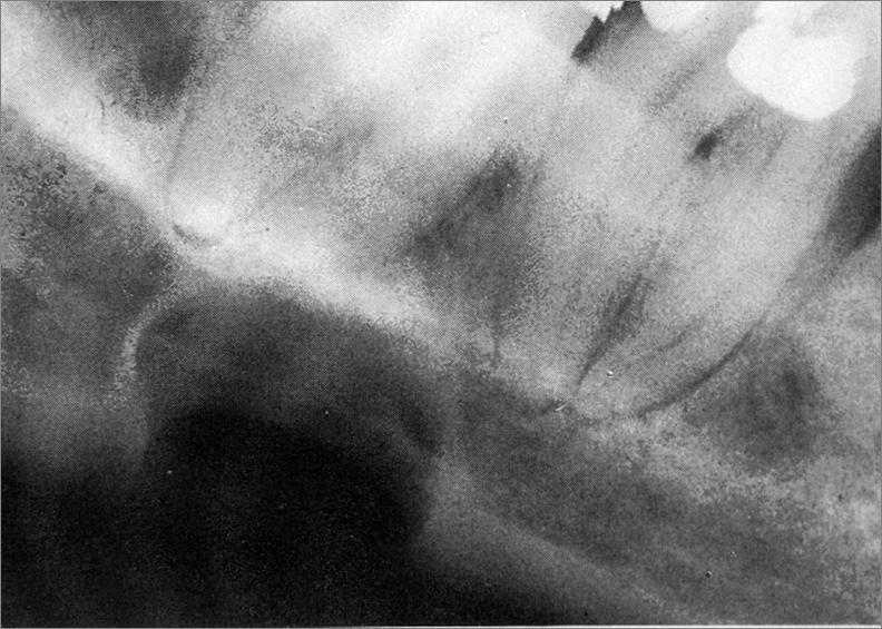 Slika 16. Stafneova cista smještena ispod mandibularnog kanala u razini donjih molara. Preuzeto s dopuštenjem doc. dr. sc. Dijane Zadravec, dr. med. 3.5.