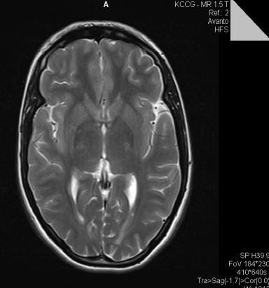 DIJAGNOSTIKA MULTIPLE SKLEROZE- MRI (magnetna rezonanca) Dr Milanka Raičević,spec.