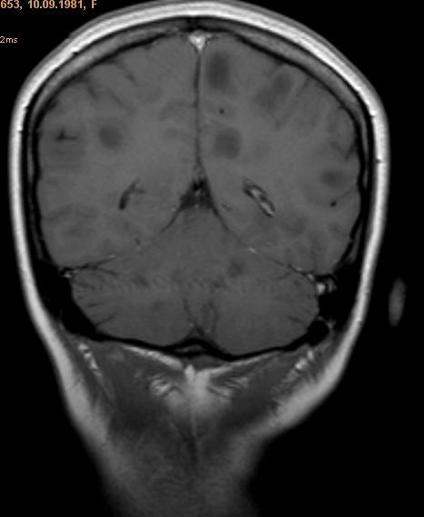 kontrola MRI ;zavisi od neurologa,obavezni