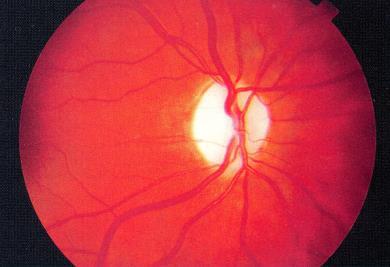 optici 20-65% Internuklearna oftalmoplegija Diplopije u 43% Intermedijalni uveitis i periflebitis retine 5,9%-50% Rijeđe:kosa devijacija,paraliza motornih nerava i hemianopsija Optički neuritis