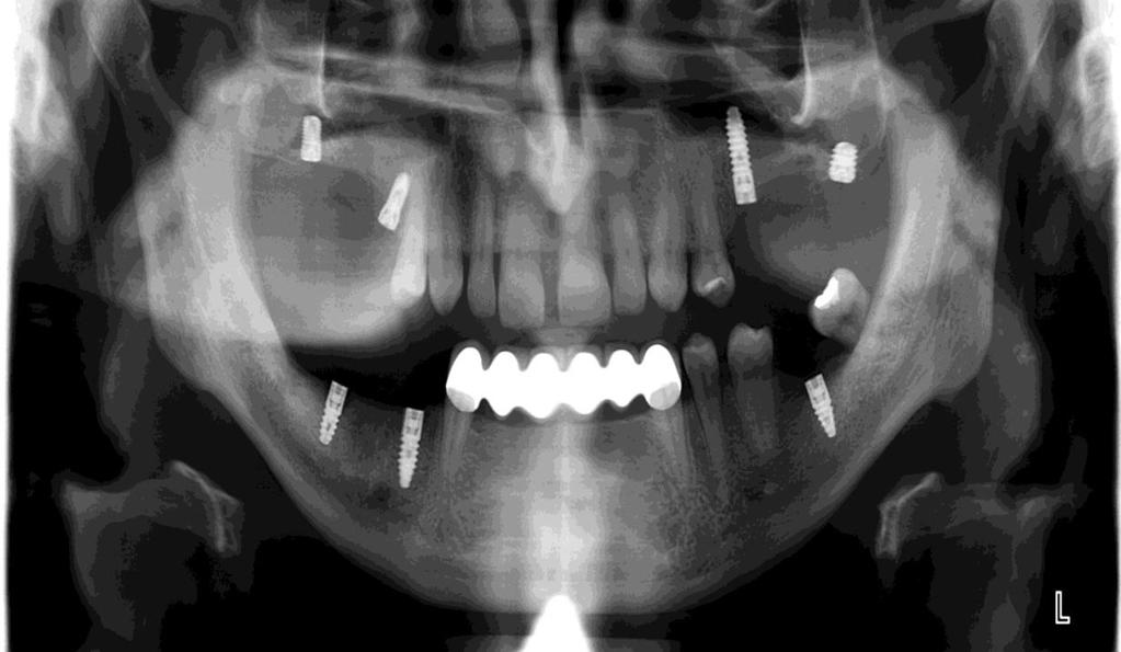 Slika 2. Ortopantomogram nakon ugradnje implantata.