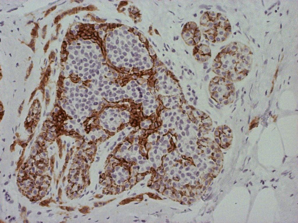 Слика 19. ECHADx100- Мембранска имунореактивност у фокусима in situ карцинома и солидним, тракастим туморским аранжманима.