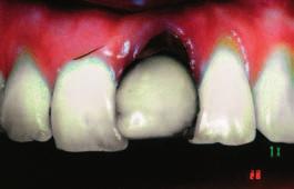 Gubitak zuba 21 zbog parodontnih razloga; žena u dobi od 30 godina Figure 6 Periodontal disease
