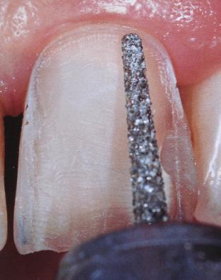 Slika 6a i 6b. Preparacija zuba u cervikalnoj trećini vestibularne površine zuba Gurel G: The Science and Art of Porcelain Laminate Veneers. Quintessence publishing 2003.