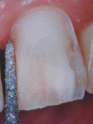 3.3.3. PREPARACIJA APROKSIMALNE POVRŠINE Preparaciju aproksimalne površine zuba je potrebno isplanirati prije preparacije vestibularne površine i oblikovanja gingivalnog ruba.