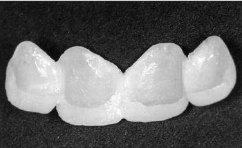 najetkati, nanijeti adheziv koji se polimerizira, te se u prozirnu foliju nanosi kompozit, koji se nakon adaptacije na zube polimerizira (4).