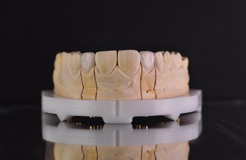 3.9. PROBA GOTOVIH KERAMIČKIH LJUSKI U fazi probe gotovih keramičkih ljuski, u ustima pacijenta se provjerava odnos rubova ljuske prema površini zuba, provjerava se odnos keramičke ljuske prema