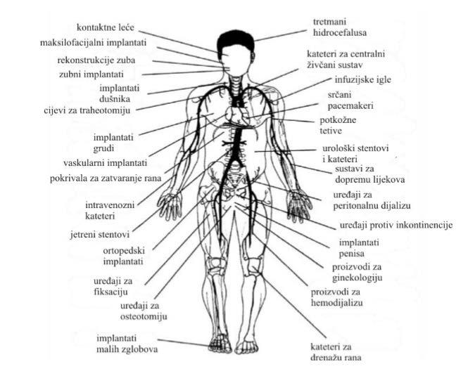 Slika 1. Prikaz ljudskog tijela te položaja na koje se ugrađuju implantati od biomaterijala koji imaju zadatak nadomještanja ili poboljšanja funkcija oštećenog, uklonjenog tkiva ili organa.