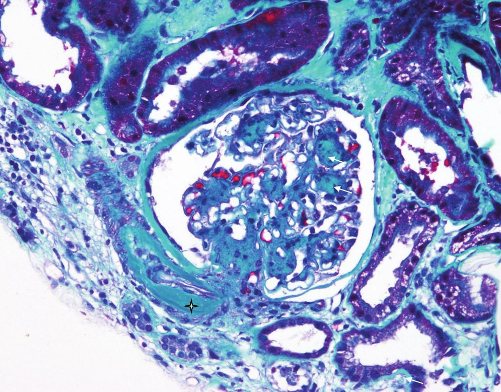 Strelice pokazuju sklerotične noduse u nodularnoj dijabetičkoj nefropatiji (Kimmelstiel Wilson). Hijalinoza aferentne i eferentne arteriole karakteristična je za dijabetičku nefropatiju (zvjezdica).