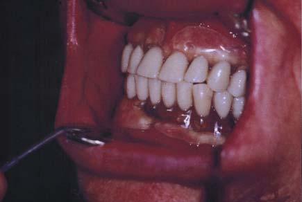 18 Stom Glas S, vol. 53, 2006. enje preostalih zuba klasi nim sistemima retencije znatno smanjuje njihov vek i rezultira prevremenim ekstrakcijama.